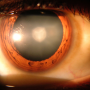 Patients with psoriasis have increased risks for cataracts, cataract surgery
